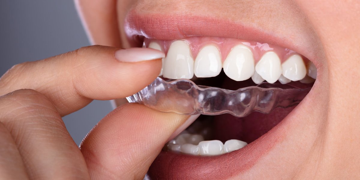 A close-up of a person placing a clear aligner tray over their teeth.