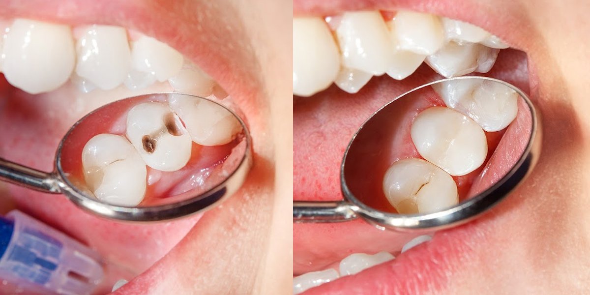 Close-up showing a tooth with cavities before treatment on the left and restored teeth after treatment on the right.