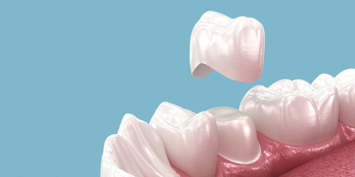 An illustration of a dental crown being placed over a prepared tooth.