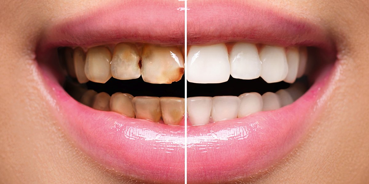 A close-up of teeth showing before and after results of dental treatment, with stained teeth on the left and white teeth on the right.