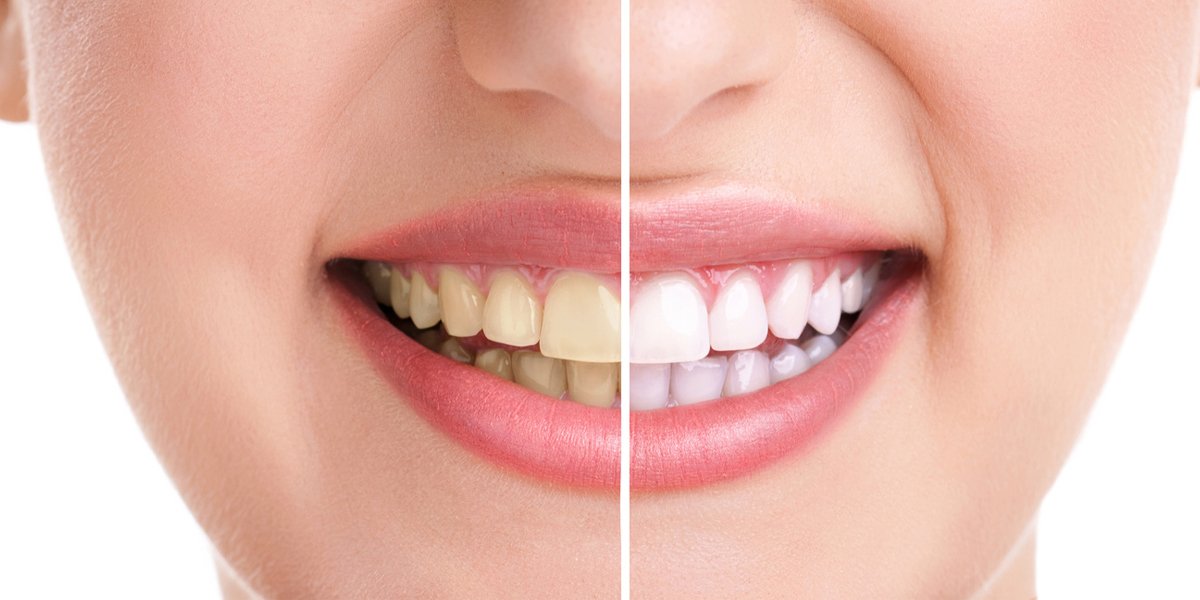 A close-up of a smile showing teeth before and after whitening, with yellowed teeth on the left and bright white teeth on the right.