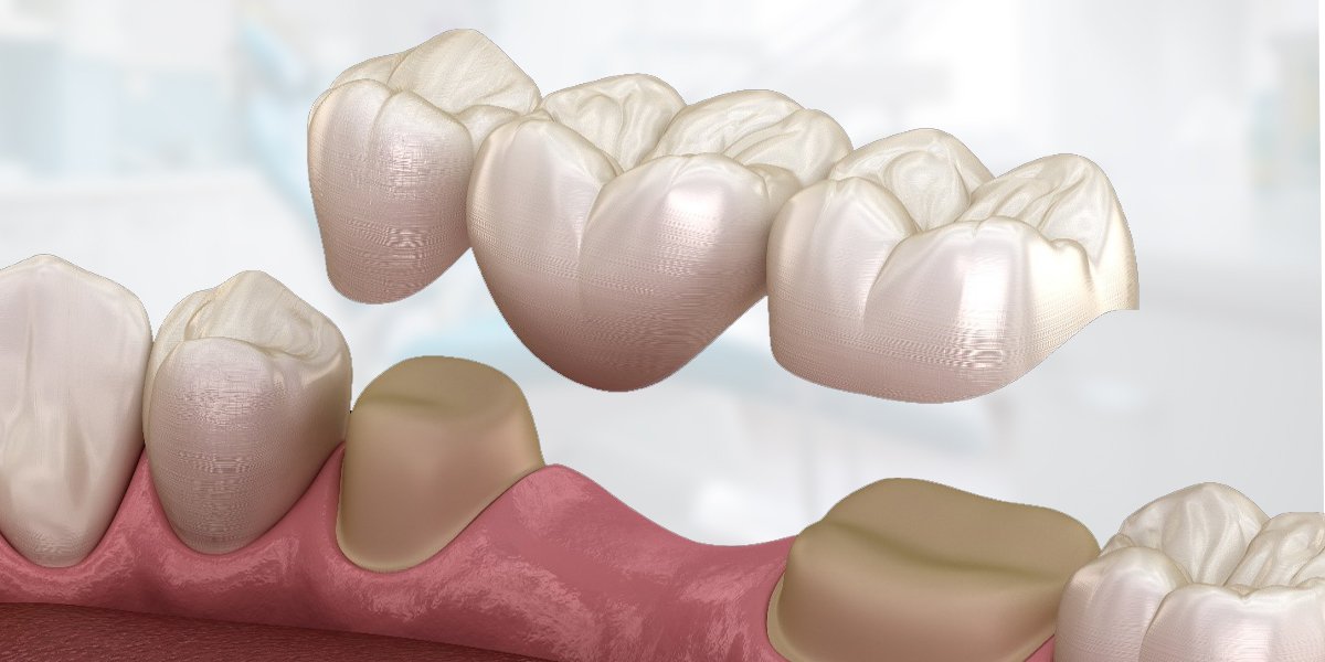 An illustration of a dental bridge being placed over prepared teeth.