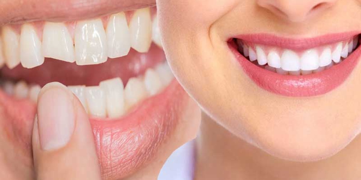 A close-up showing chipped teeth on the left and a bright, even smile on the right.