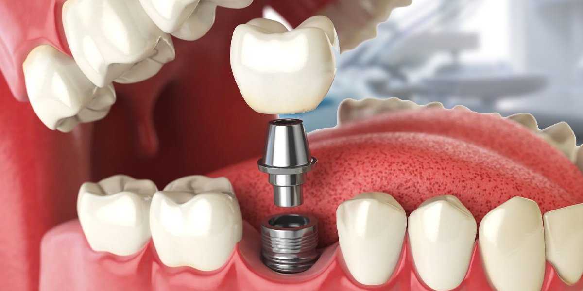An illustration of a dental implant showing the crown, abutment, and implant post inside the jaw.
