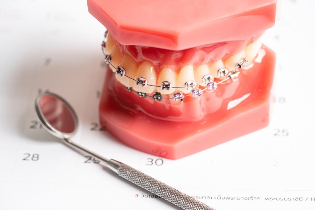 A dental model with braces and gums, shown with a dental mirror tool.