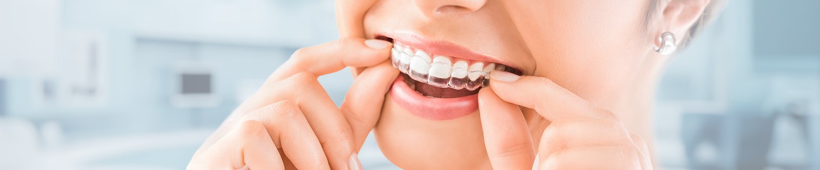 Close-up of a person putting on clear aligner trays over their teeth.
